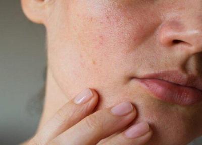 پوست و ظهور 6 نشانه بیماری